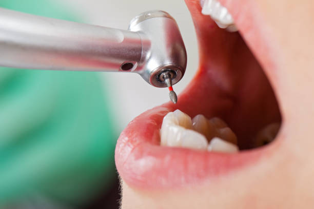 Best Emergency Root Canal Therapy in Lakeside, TX